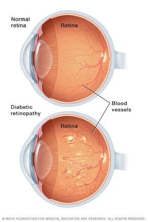 normal retina and diabetic retinopathy